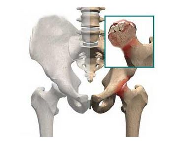 股骨头坏死